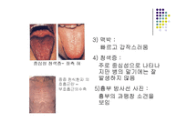 [질환별 물리치료] 천식 Asthma-6