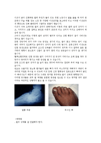 [질환별 물리치료] 하지절단에 관해서-11