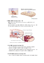 뇌손상 - cva[Cerebral Vascular Accident] 에 대해-4