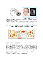 [물리치료] 뇌졸중에 관한 내용과 치료에 관해-3