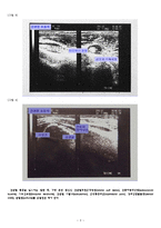 [재활의학] Frozen Shoulder[동결견; 오십견]-3