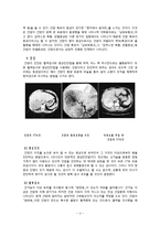 [성인간호학][HCC][간암][간세포암] 케이스 스터디(Case Study), 문헌고찰(hepatocellular carcinoma)-4