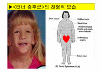 [특수교육] 정신지체의 생물학적 원인, 정신지체의 다양한 원인, 질병등-12