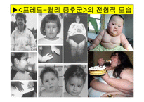 [특수교육] 정신지체의 생물학적 원인, 정신지체의 다양한 원인, 질병등-18