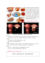 간호학 케이스 스터디 - 난소종양(ovarian tumors)-3