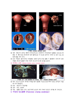 간호학 케이스 스터디 - 난소종양(ovarian tumors)-4