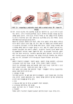 간호학 케이스 스터디 - 난소종양(ovarian tumors)-5