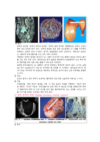 간호학 케이스 스터디 - 난소종양(ovarian tumors)-9