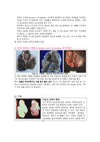 간호학 케이스 스터디 - 난소종양(ovarian tumors)-10