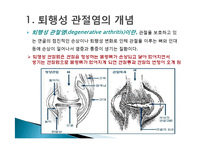 [현대인과 성인병] 퇴행성 관절염의 원인 및 증상과 치료-3