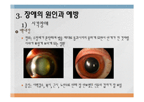 장애의 원인과 예방-10
