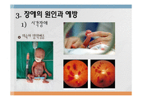 장애의 원인과 예방-15