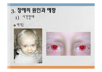 장애의 원인과 예방-17