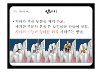 연령별 치과 치료와 치과용 재료-11
