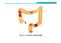 암의 종류와 영영요법 및 관리법-14