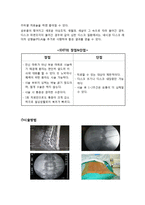 [의학] 고주파열 디스크 시술(Intra Discal Electrothermical Theraphy)-2