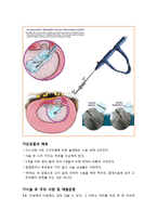 [의학] 고주파열 디스크 시술(Intra Discal Electrothermical Theraphy)-4