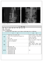 척추관 협착증(spinal canal stenosis)환자 case study-6