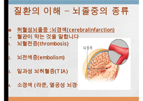 뇌졸중, 뇌졸중이란, 뇌졸중종류, 뇌졸중합병증, 뇌졸중후유증, 뇌졸중예후, 재활치료, 사회복지사의개입, 뇌졸중에 대한 사례,-3
