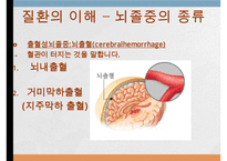 뇌졸중, 뇌졸중이란, 뇌졸중종류, 뇌졸중합병증, 뇌졸중후유증, 뇌졸중예후, 재활치료, 사회복지사의개입, 뇌졸중에 대한 사례,-4
