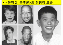[특수교육] 정신지체의 생물학적 원인, 정신지체의 다양한 원인, 질병등 수정 다운 홍보-8