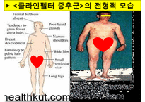 [특수교육] 정신지체의 생물학적 원인, 정신지체의 다양한 원인, 질병등 수정 다운 홍보-10