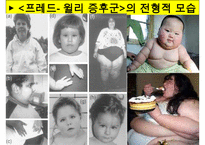 [특수교육] 정신지체의 생물학적 원인, 정신지체의 다양한 원인, 질병등 수정 다운 홍보-18