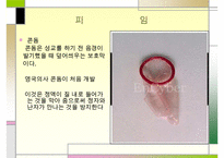 낙태 문제의 해결책 피임방법] 낙태의 개념과 증가 원인 및 낙태의 문제점과 대책방안으로서의 피임에 대하여 수정 다운 홍보-17