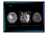 [의료사회사업] 신경외과수술거부 사례에 따른 사회복지사의 개입-11