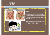 복막염, penperitonitis, 복막염 케이스스터디, case study, 간호과정, 복막염 수술 후 관리, SOAPIE,-4