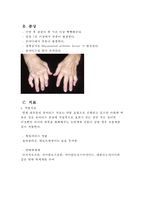 [자가 면역 질환] 자가면역질환의 발생기전 및 조절 기술 - 자가 면역 질환 개념, 자가 면역 질환 연구, Rheumatoid arthritis, Rheumatoid arthritis 치료, 자가 면역질환의 연구과정-9