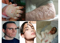 [화상환자의 심리 사회적 문제와 의료사회복지 서비스] 화상환자 심리적 문제점, 화상환자 특징, 화상환자 치료방안, 회상환자 의료 서비스, 화상환자 가족의 개입사례-1