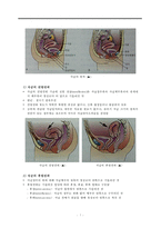 생식기의구조이상, 생식기기형, 성선발육장애, 자궁의위치이상, 외생식기기형, 처녀막폐쇄증, 난소기형, 반음양, 자궁전방전위, 자궁후방전위-8