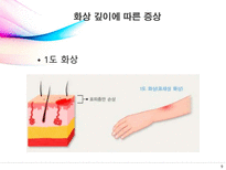 [의료사회복지] 화상에 대한 이해-9