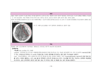급성경막하출혈 케이스스터디-19