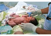 Neonatal suction 신생아 흡인의 문제점 고찰-4
