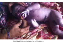 Neonatal suction 신생아 흡인의 문제점 고찰-5