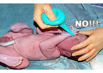 Neonatal suction 신생아 흡인의 문제점 고찰-8