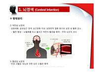 뇌경색(Cerebral Infarction) 병태생리-9
