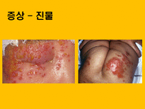 자연과학 아토피 자연의 역습 재앙으로 돌아온 환경성질환-20