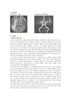 동서협진과 CASE CB-Infarction으로 인한 편측 마비로 의-2