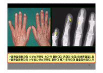 의약학 관절염-16