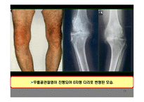 의약학 관절염-17