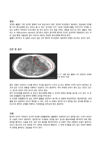 간호진단 신경외과 만성 경막하 출혈 케이스 chronic subdural hemorrhage-2