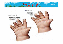 묘성 증후군과 윌리엄스 증후군-10