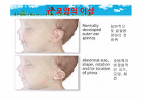 묘성 증후군과 윌리엄스 증후군-13