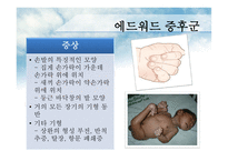 에드워드&파타우증후군 원인과 치료-6
