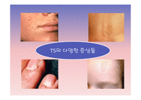 정신지체발표 - 결절성 경화증과 태아 알코올 증후군-4