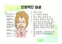 묘성&윌리엄스 정의, 원인, 진단, 특성-9