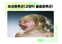 묘성&윌리엄스 정의, 원인, 진단, 특성-14